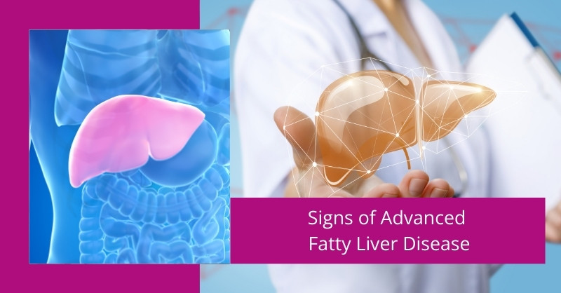 Signs of Advanced Fatty Liver Disease
