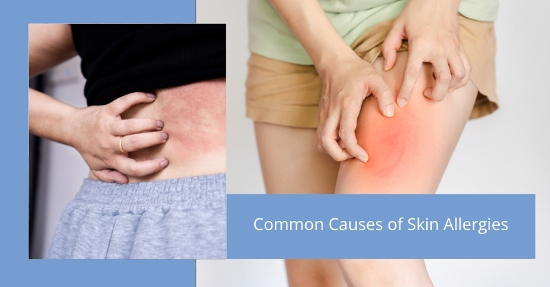 Common Causes of Skin Allergies