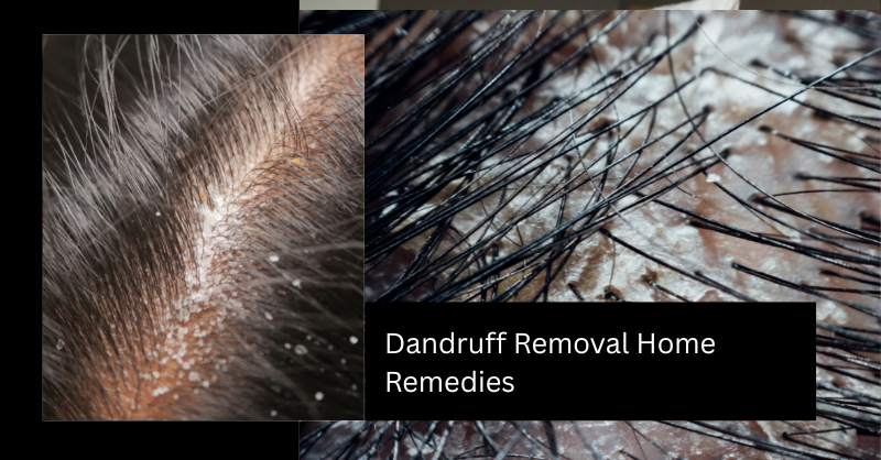 aloe vera for dandruff, aloe vera gel for dandruff, aloe vera gel hair mask for dandruff, amla for dandruff, amla powder for dandruff, amla powder hair mask for dandruff, apple cider vinegar for dandruff, apple cider vinegar hair rinse for dandruff, apple cider vinegar rinse for dandruff, baking soda for dandruff, baking soda hair scrub for dandruff, baking soda scrub for dandruff, best home remedies for dandruff, coconut oil for dandruff