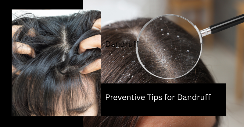 Preventive Tips for Dandruff