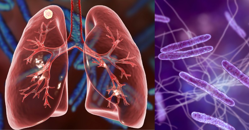 active TB, antibiotic resistance, BCG vaccine, best treatment for tuberculosis, bronchitis, causes of tuberculosis, chest pain tuberculosis, chest x-ray tuberculosis, cough remedies, DOTS therapy, drug-resistant TB, early signs of tuberculosis, extrapulmonary tuberculosis